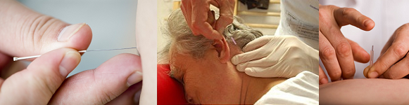 dry-needling